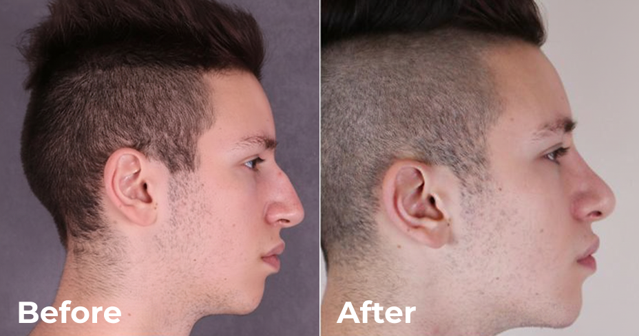 قبل وبعد - دكتور التجميل عمر فودة