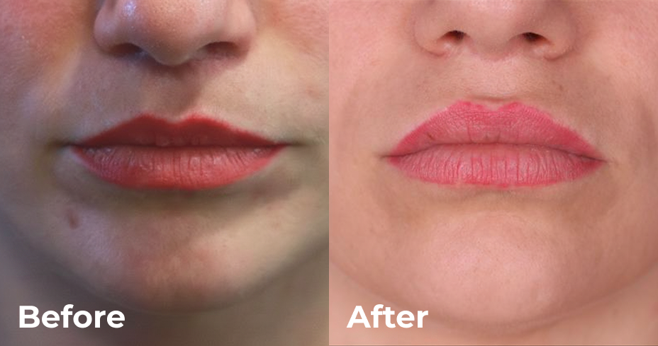 قبل وبعد - دكتور التجميل عمر فودة