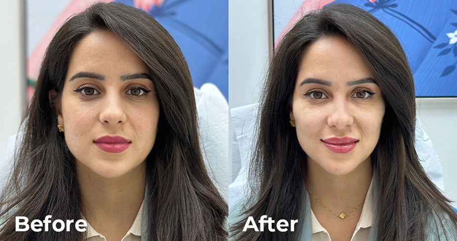 قبل وبعد - دكتور التجميل عمر فودة